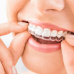 Orthodontic Solutions for Overcrowded Teeth