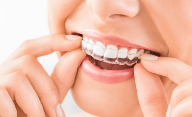 Orthodontic Solutions for Overcrowded Teeth