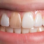 The Advantages of Dental Implants Over Dentures