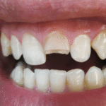 The Artistic Side of Veneers
