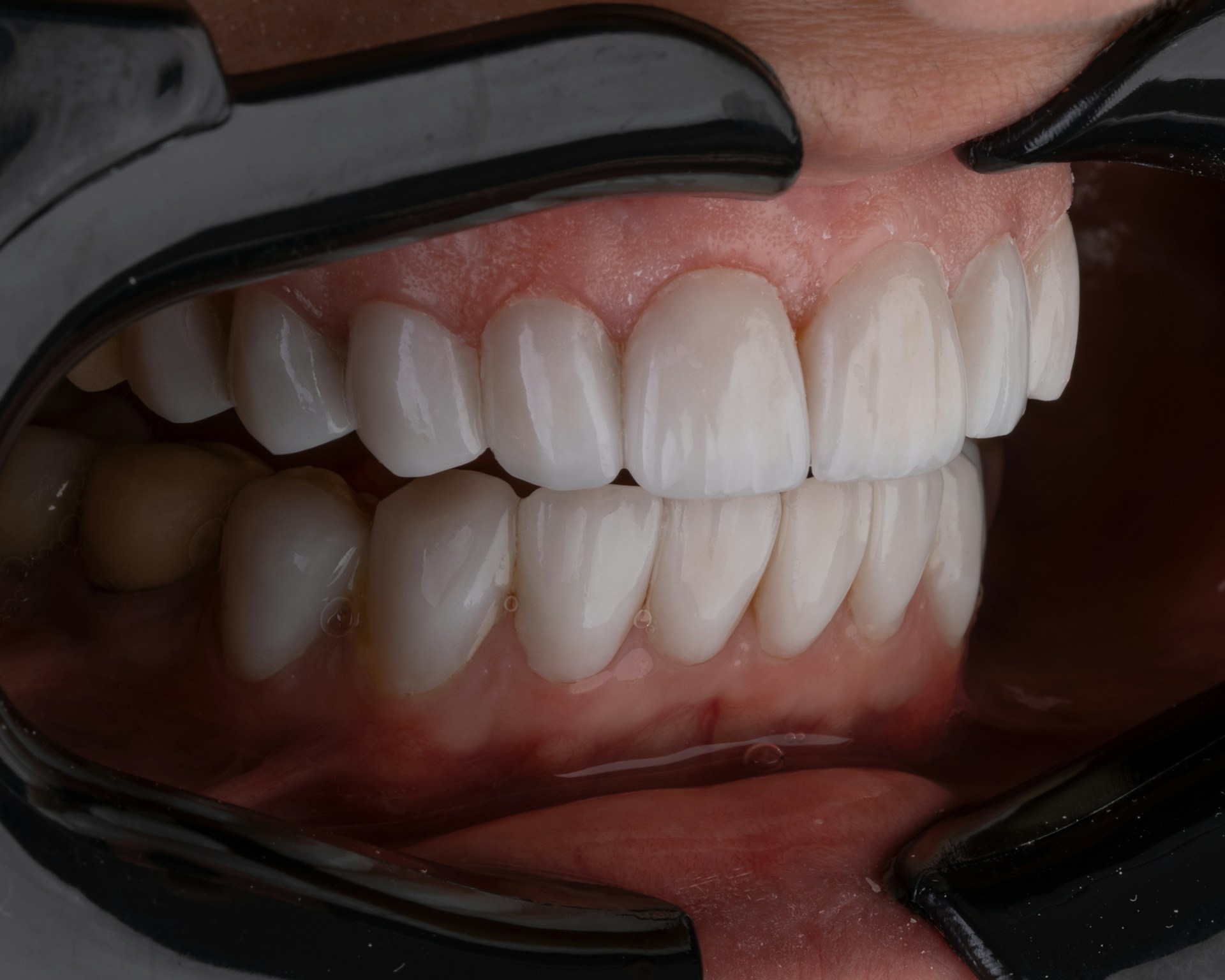 What To Do if Your Veneers Are Chipped or Broken