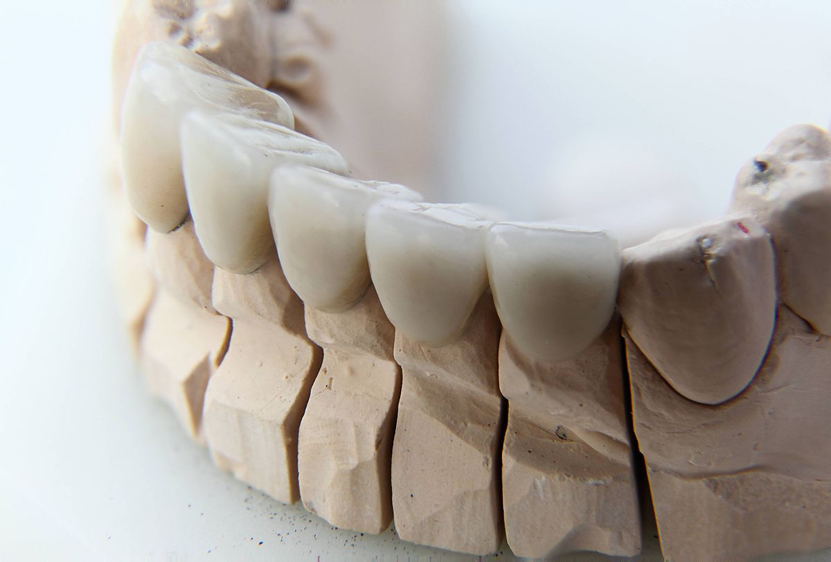Why Crowns Are Essential for Restoring Teeth After Trauma