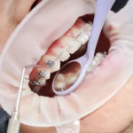Why Regular Visits to the Dentist Are Crucial for Preventing Tooth Loss