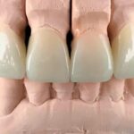 When Are Dental Crowns Necessary and What To Expect