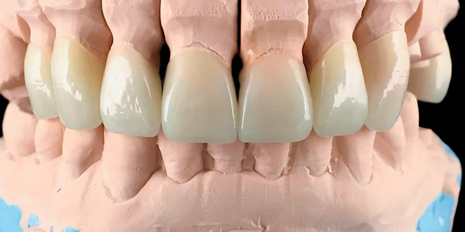 When Are Dental Crowns Necessary and What To Expect