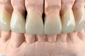 When Are Dental Crowns Necessary and What To Expect