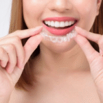 When To Ask a Cosmetic Dentist About Clear Aligners