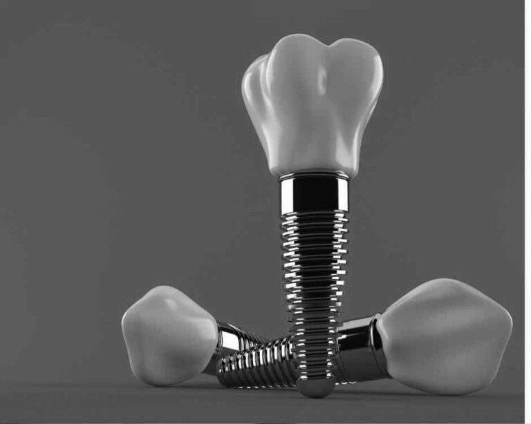 Dental Implants for Older Adults: Why Age Doesn’t Matter
