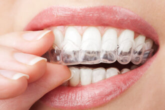 Exploring the Cost of Invisalign vs. Traditional Braces