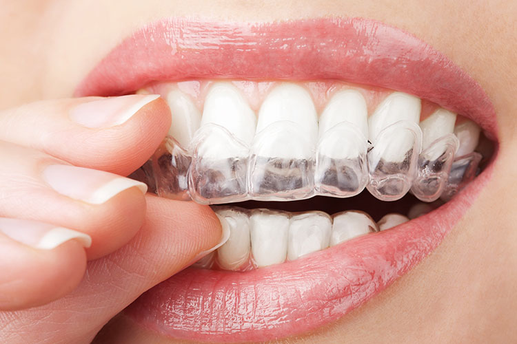 Exploring the Cost of Invisalign vs. Traditional Braces