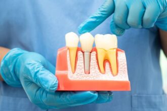 How Root Canals Can Save Your Teeth from Being Extracted