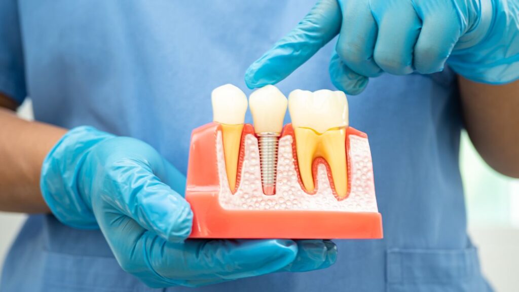 How Root Canals Can Save Your Teeth from Being Extracted