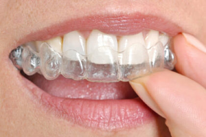 Maintaining Dental Hygiene with Invisalign Aligners