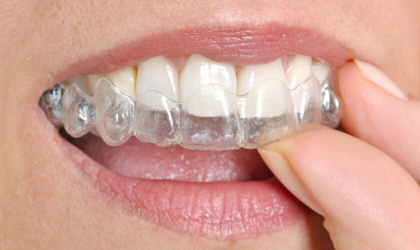 Maintaining Dental Hygiene with Invisalign Aligners