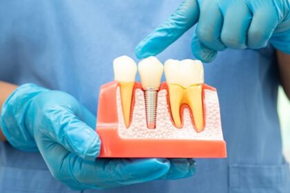 The Impact of Dental Implants on Overall Health and Wellness
