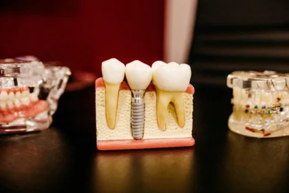 When Are Dental Crowns Necessary?