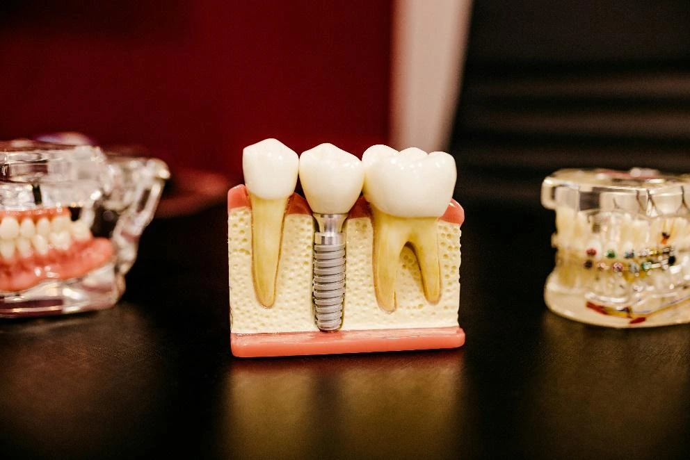When Are Dental Crowns Necessary?