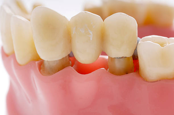 Why Crowns and Bridges Are Essential for Long-term Oral Health