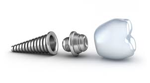 Common Questions About Dental Implants