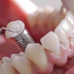How Dental Implants Provide a Permanent Solution for Tooth Loss