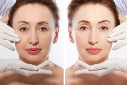 Benefits of a Face Lift for a Youthful Appearance