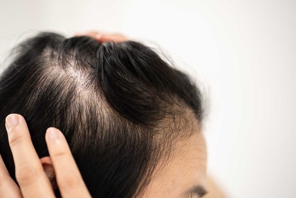 Common Causes of Hair Loss in Men and Women