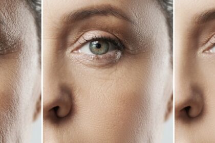 Comparing Botox and Dermal Fillers