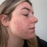 Effective Strategies for Managing Acne in Teenagers