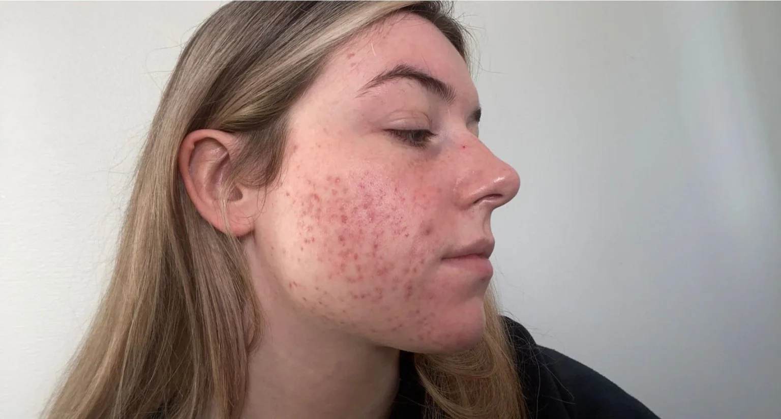 Effective Strategies for Managing Acne in Teenagers