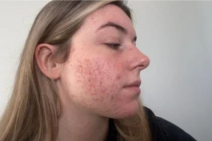 Effective Strategies for Managing Acne in Teenagers