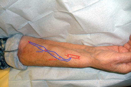 How To Choose the Right Dialysis Access Method