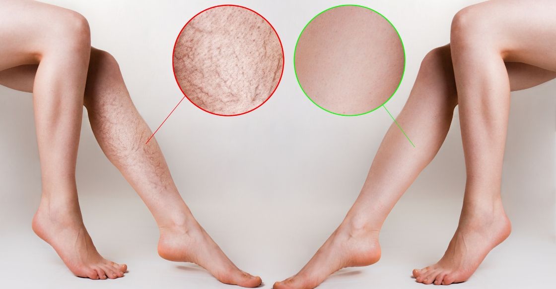 How Varithena Helps With Varicose Vein Treatment