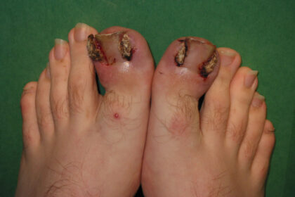 How to Cope with Ingrown Toenails