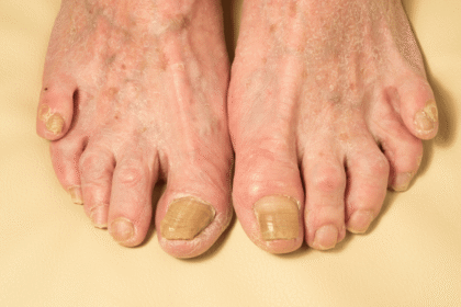 How to Identify and Treat Foot Fungus