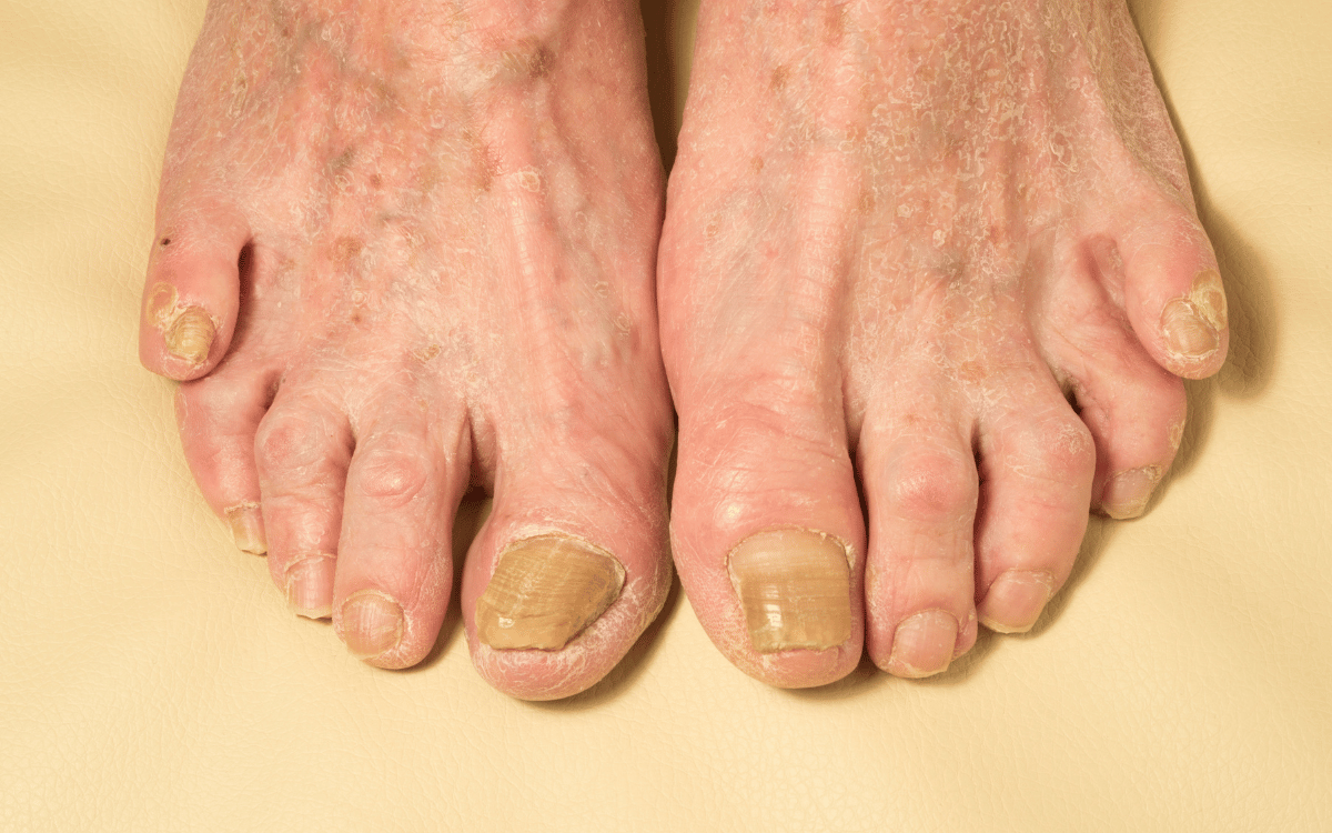 How to Identify and Treat Foot Fungus