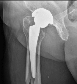 Innovations in Hip Replacement Techniques and Materials