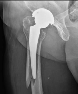 Innovations in Hip Replacement Techniques and Materials