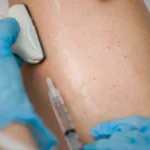 Lifestyle Changes To Alleviate Symptoms of Varicose Veins