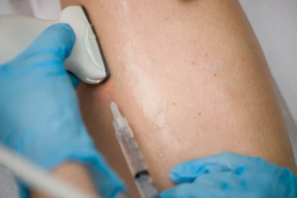 Lifestyle Changes To Alleviate Symptoms of Varicose Veins