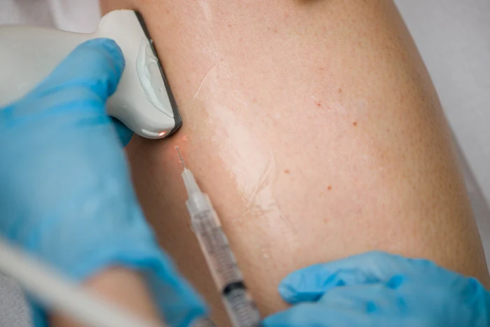 Lifestyle Changes To Alleviate Symptoms of Varicose Veins