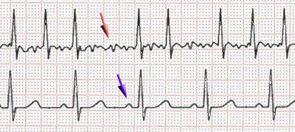 Lifestyle Changes and Management Strategies for Atrial Fibrillation