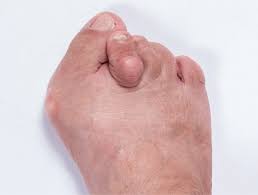 Managing Pain and Discomfort Associated with Bunions