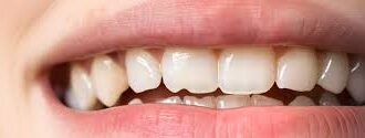 Recognizing Cracked Teeth and What You Should DoRecognizing Cracked Teeth and What You Should Do