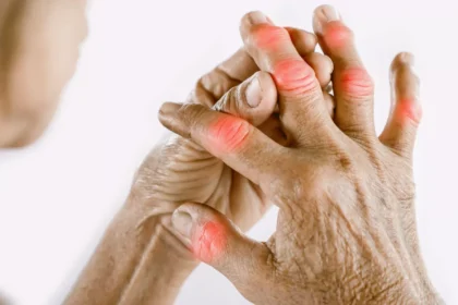Recognizing the Signs of Arthritis Early
