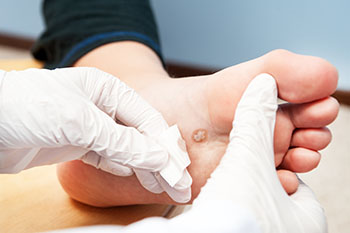 Symptoms and Treatments for Plantar Warts