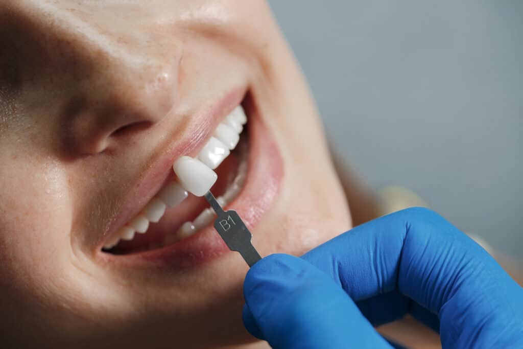 The Benefits of Porcelain Veneers for Enhancing Your Smile
