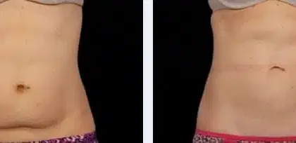 Understanding the Benefits of Cool Sculpting for Body Contouring
