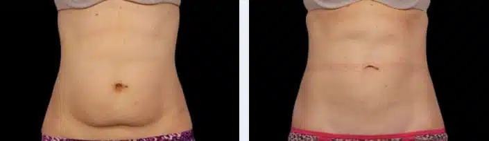 Understanding the Benefits of Cool Sculpting for Body Contouring