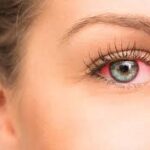 Understanding the Causes and Symptoms of Dry Eyes
