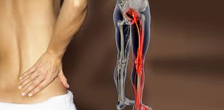 Understanding the Causes and Symptoms of Sciatica